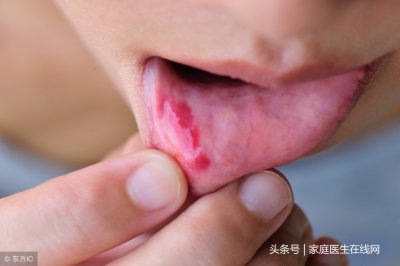 ​应激性溃疡 提前做好防护是关键
