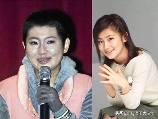 任家萱她烧伤后复原多少？看看她烧伤前后对比图片就知道