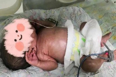​火棉胶婴儿是什么原因造成的如懿传怪胎图片火棉胶婴儿