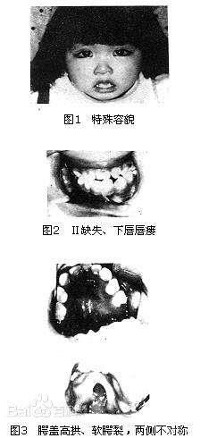 歌舞伎面谱综合征的症状照片跟化妆了一样 这病可以治愈吗