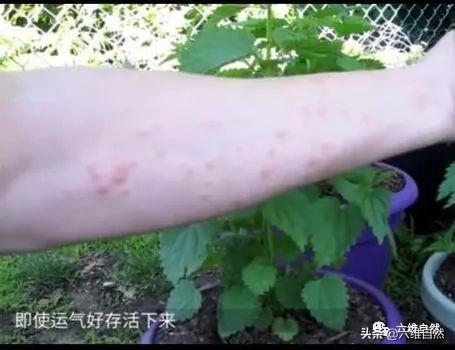 金皮树外表无毒无害，是被公认世界最毒树之一，被刺如硫酸般灼烧