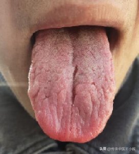 ​舌头上有裂纹，分不清阳虚？阴虚？一个视频教你对照自测！