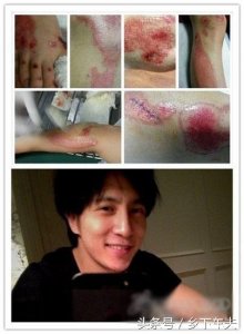 ​薛之谦车祸受伤照曝光，脚被钢钉刺穿血肉模糊