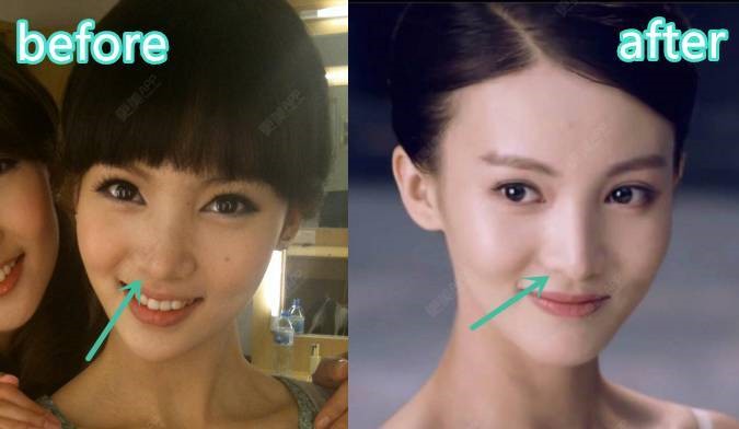 金晨怎么变丑了鼻子怎么了脸怎么那么歪?金晨肯定整容失败细节图