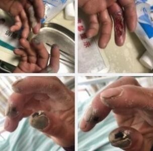 ​环卫工双手被垃圾腐蚀，遇到强酸强碱腐蚀该咋办？
