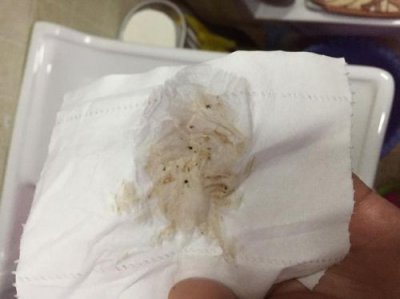 ​怀孕分泌物会增多吗(怀孕分泌物增多发黄)