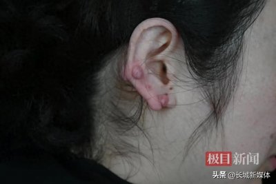 女子长年戴耳环不摘,双耳竟结“葡萄”