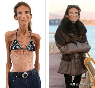 ​最瘦的人到底有多瘦？瘦到只有皮包骨头，谨防过度减肥