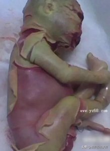 ​今天带大家了解一下:火棉胶婴儿。